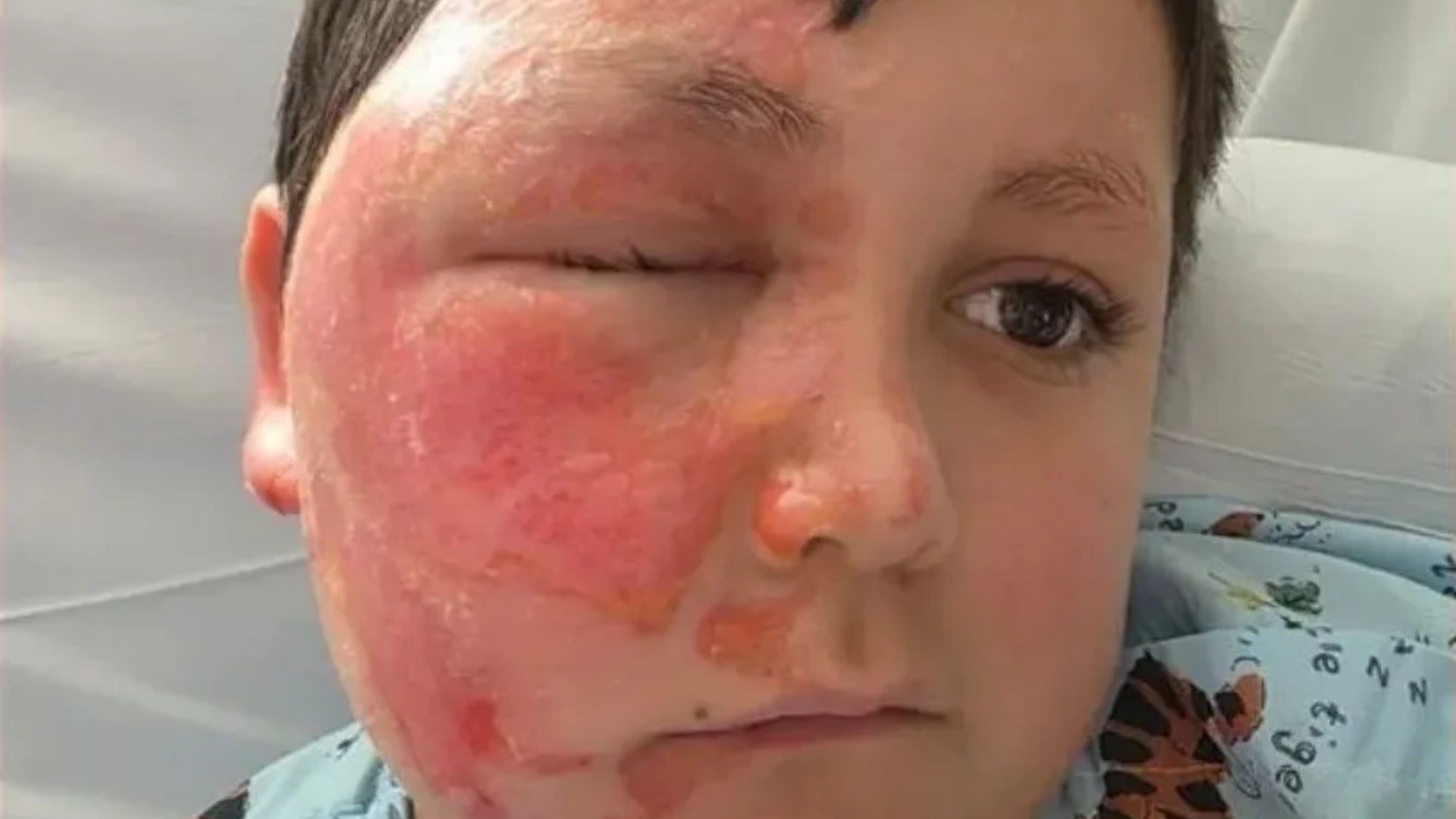 Enfant de 9 ans gravement brûlé par un horrible défi TikTok : Sa mère alerte sur les dangers d'un "visage en train de fondre"