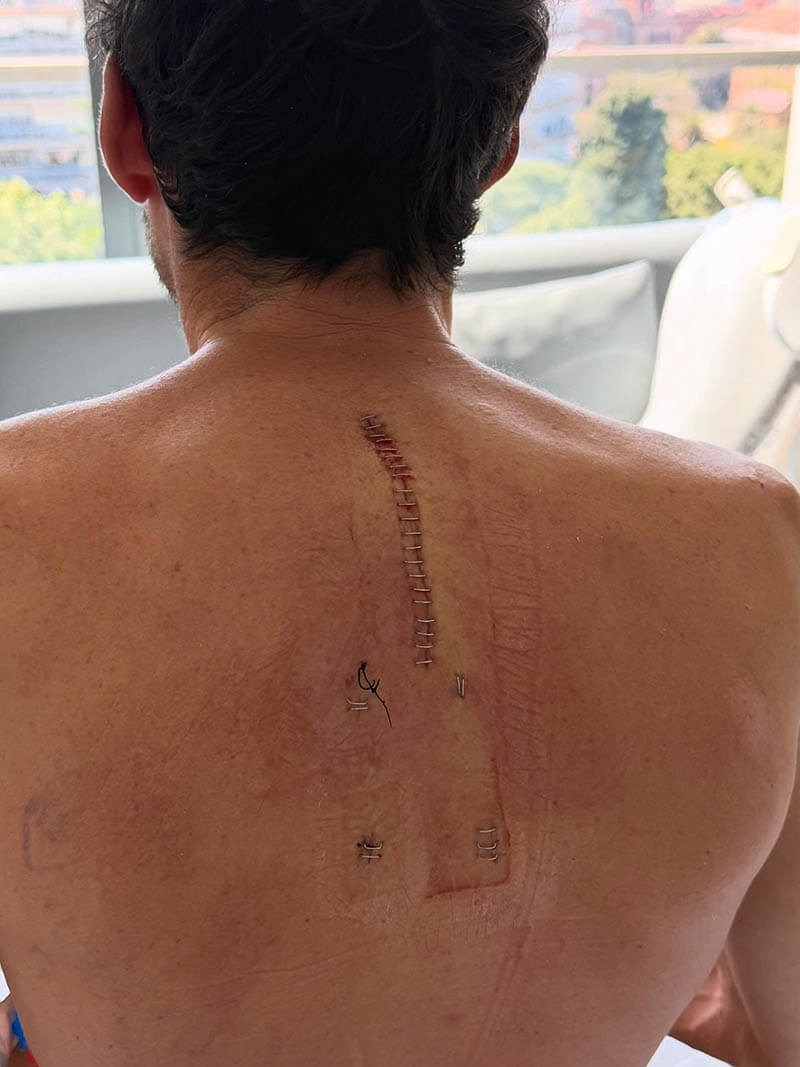 Blessure d'Espargaró en MotoGP